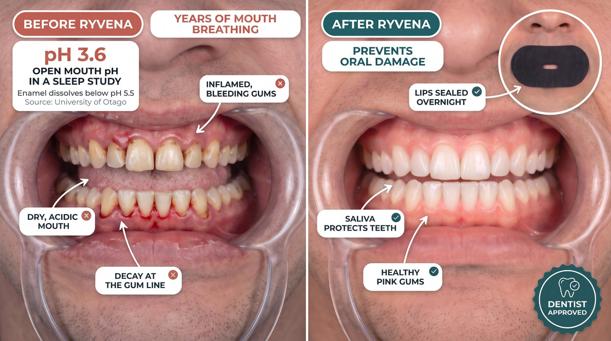Before and after RYVENA: a dental photo of a mouth breather's inflamed, bleeding gums, decay at the gum line and dry mouth, beside healthy pink gums and clean teeth after taping with RYVENA.